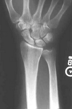 Frontal X-ray of a normal wrist
