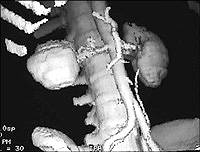 CT arteriogram of the abdominal aorta.