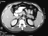 Normal CT of the abdomen
