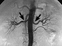 Normal renal angiogram.