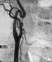 Normal carotid arteriogram.
