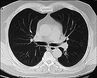Normal CT of the chest.