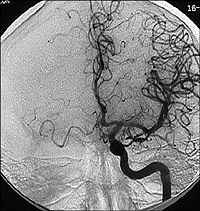 Normal frontal cerbral arteriogram