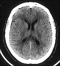 CT of a normal brain.