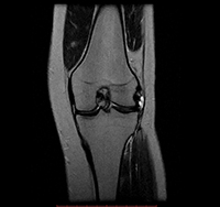 Normal MRI of the knee