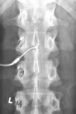Myelogram showing needle placement