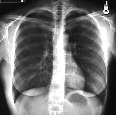 Normal chest X-ray.