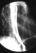 X-ray of normal esophagus.
