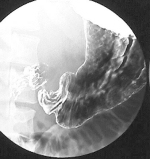 Normal stomach seen through a fluoroscope.