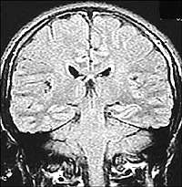 Normal MRI of the brain.