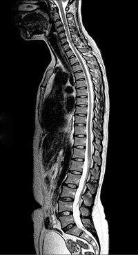 Normal spine MRI